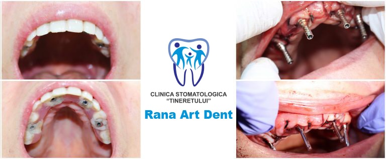 Implant-Dentar-Fast-Fixed-Rapid-434-min